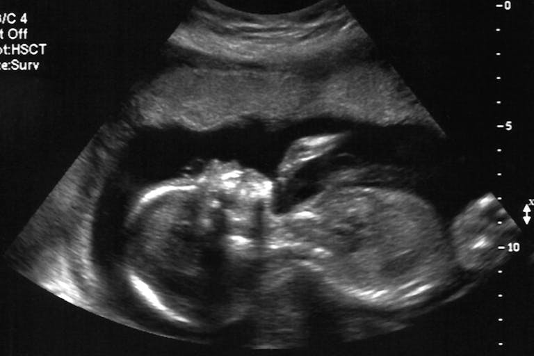 abortion, ultrasound, BBC, pregnancy, abortion restrictions