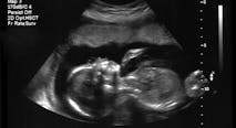 abortion, ultrasound, BBC, pregnancy, abortion restrictions