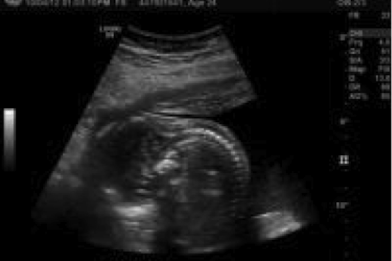ultrasound of Juth