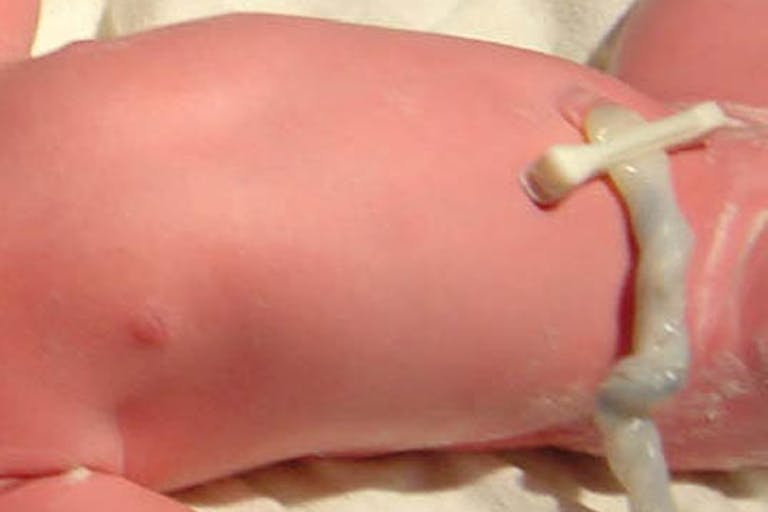 Umbilical Cord