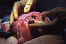 During a procedure to correct spina bifida while still in the womb, Samuel Armas, 21 weeks old in the womb, was having surgery to correct spina bifida. The surgeon was Dr. Joseph P. Bruner. (Photo credit: Michael Clancy) spina bifida, Hand of Hope