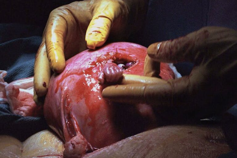 During a procedure to correct spina bifida while still in the womb, Samuel Armas, 21 weeks old in the womb, was having surgery to correct spina bifida. The surgeon was Dr. Joseph P. Bruner. (Photo credit: Michael Clancy) spina bifida, Hand of Hope