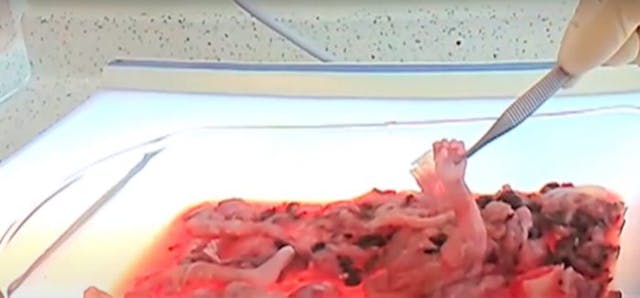 Screenshot from CMP video of second trimester abortion