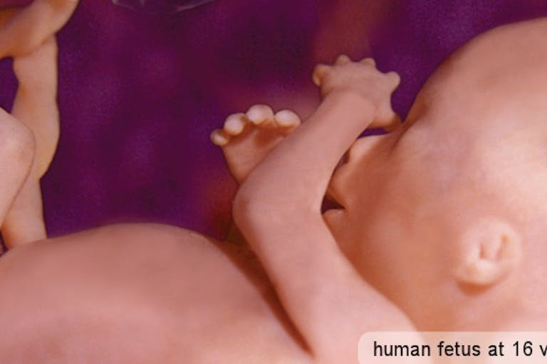 Human at about 16 weeks gestation. abortion
