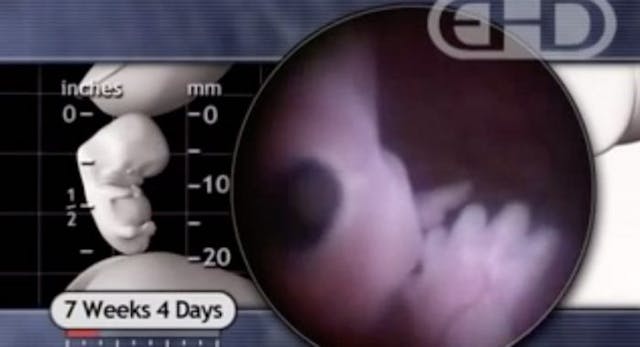 7 week embryo (Endowment for Human Development) heartbeat, embryo