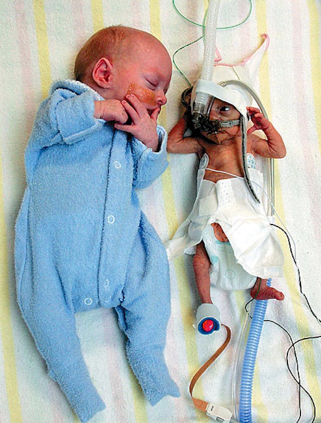 Prenatal surgery for twin-to-twin transfusion syndrome is saving lives image