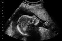 heartbeat, pro-life, ultrasound, pro-life, abortion