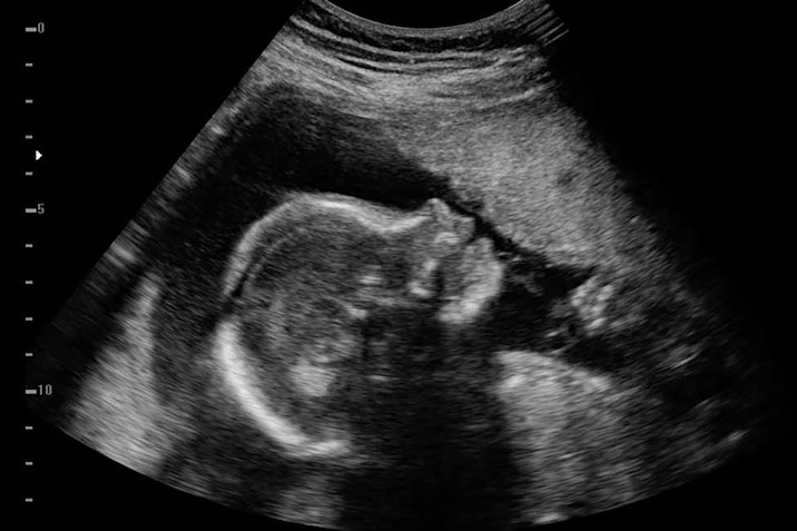 heartbeat, pro-life, ultrasound, pro-life, abortion