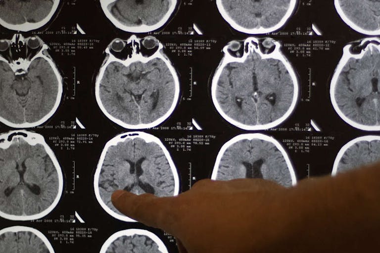 brain tomography