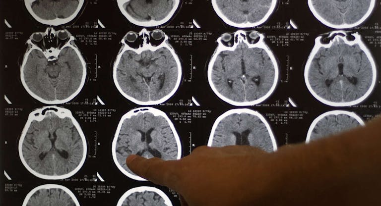 brain tomography