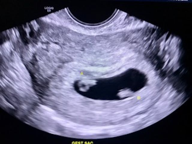 Ultrasound of Kristen McKinnis’s twins. Photo courtesy of Kristen McKinnis. Do not reprint. ectopic, twins, kristen mcginnis