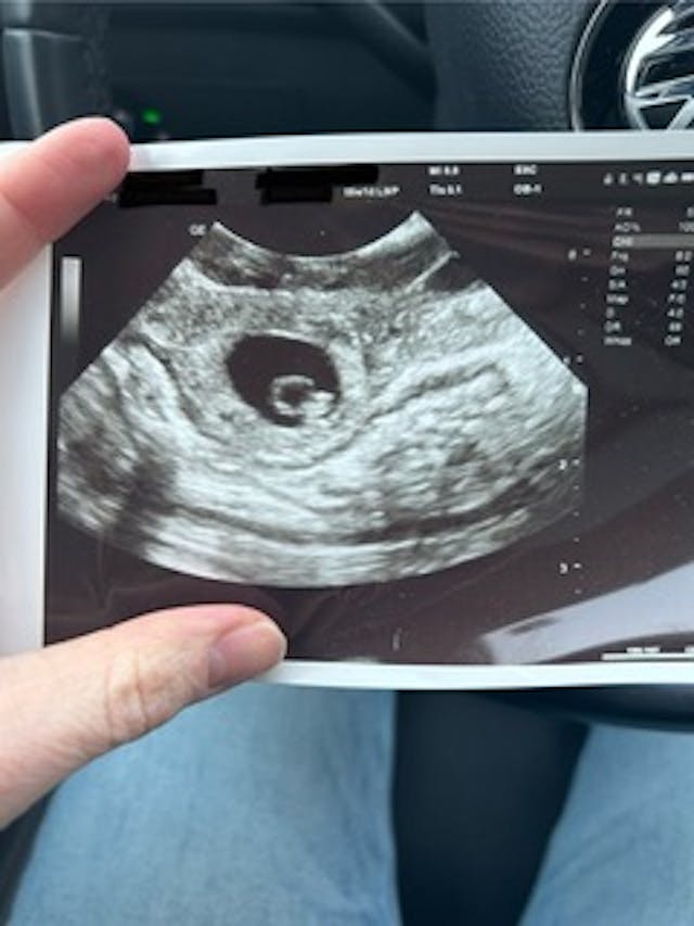 Ultrasound of Kristen McKinnis’s baby. Photo courtesy of Kristen McKinnis. Do not reprint. ectopic, twins, kristen mcginnis