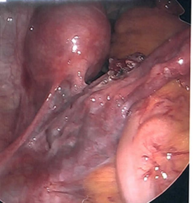 Photo of Kristen McKinnis’s baby. Photo courtesy of Kristen McKinnis. Do not reprint. ectopic, twins, kristen mcginnis