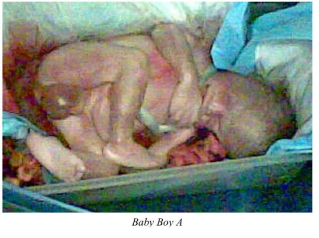 Gosnell killed Baby Boy A after he was born.