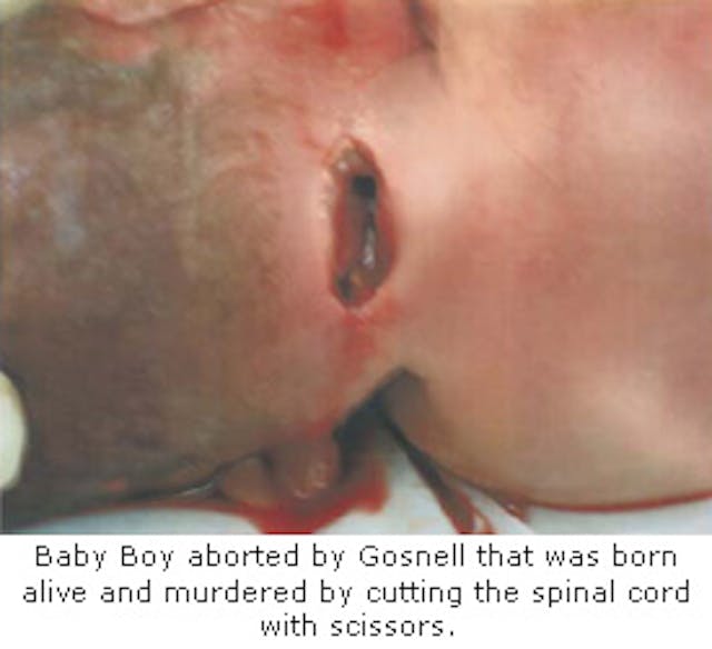 Abortionist joked about killing 30-week infant: This baby is ‘big enough’ to ‘walk me to the bus stop’ image
