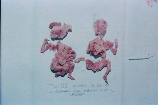 These 10 photos show the reality of late-term abortion image