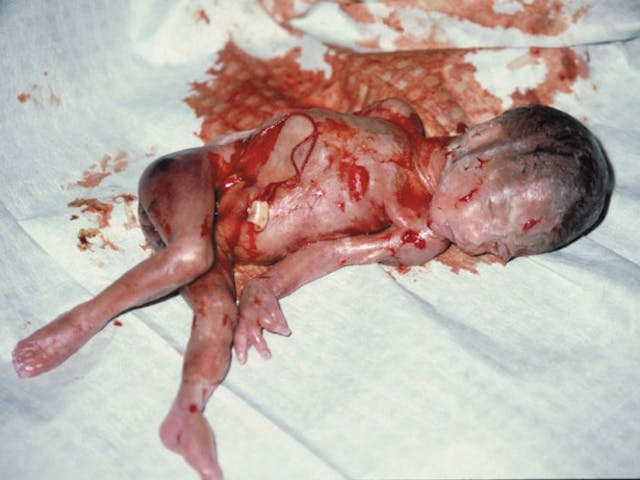 22 week abortion (from abortionno.com) 22 week abortion (from abortionno.com)