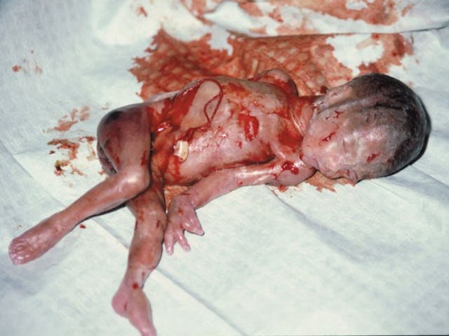 22 week abortion (from abortionno.com)