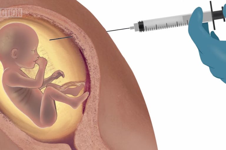third-trimester abortion, abortion
