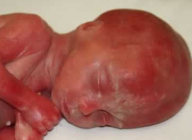 fetus baby abortion