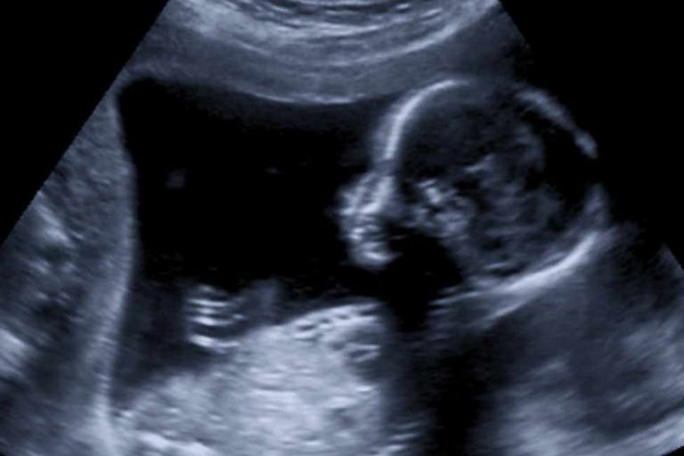 abortion, disability, ultrasound