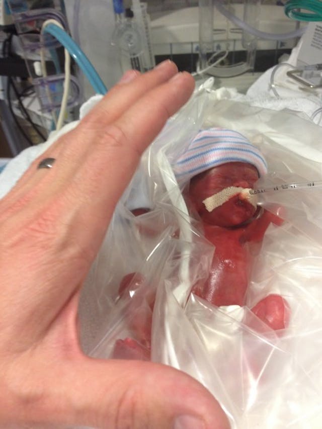 The first photo taken of Naomi on the day of her birth weighing just 364 grams. Photo courtesy of Michael and Angela Bakker. Do not reprint. abortion, Naomi Bakker