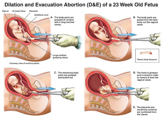 Former abortion worker reveals the horror of D&E abortions image