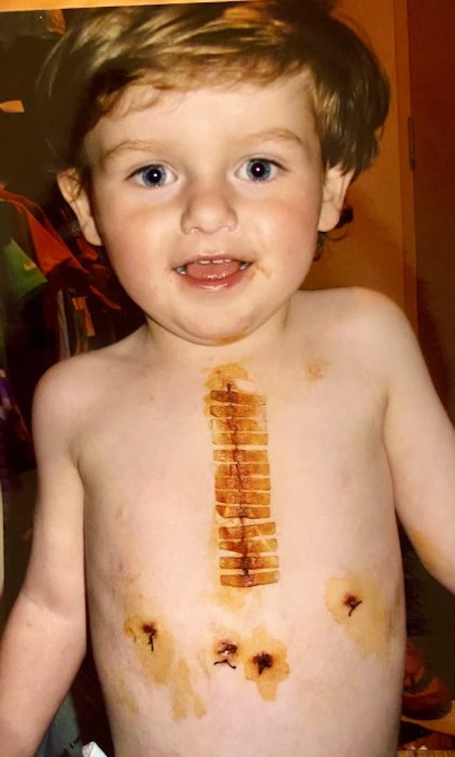 Tate following surgery. Photo courtesy of the Lewis Family. Do not reprint. Tate following surgery. Photo courtesy of the Lewis Family. Do not reprint.