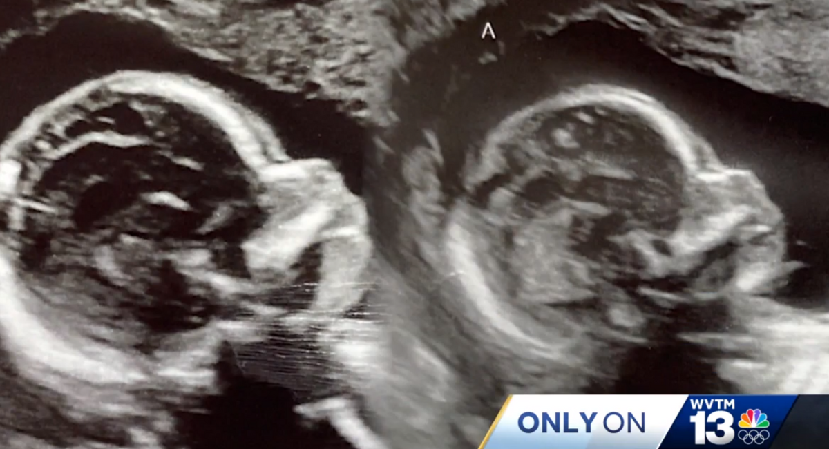Mom with two uteruses expecting twins in ‘one in a million’ pregnancy