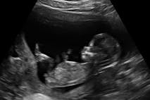 11 week old fetus