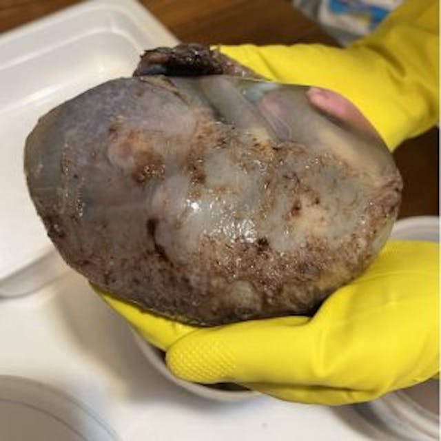 Baby Phoenix was found still in the amniotic sac in a medical waste bin outside of a DC abortion business (late second or early third trimester). Baby Phoenix was found still in the amniotic sac in a medical waste bin outside of a DC abortion business (late second or early third trimester).