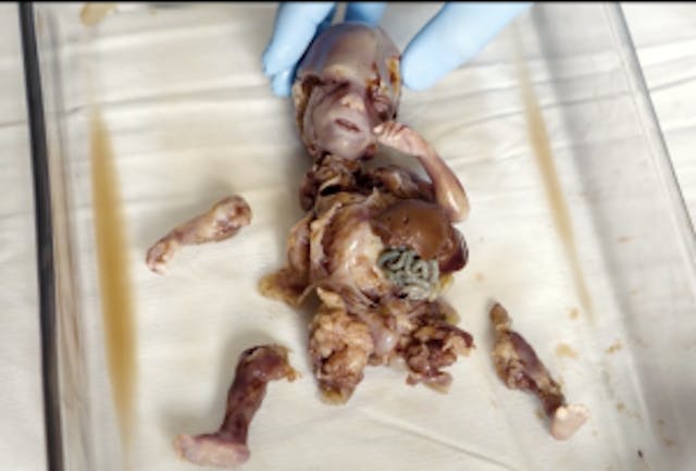 Baby Angel was killed by dismemberment abortion late in pregnancy and his body was found in a medical waste bin outside a DC abortion business. (Photo credit: PAAU) Justice for the Five (Photo via PAAU)