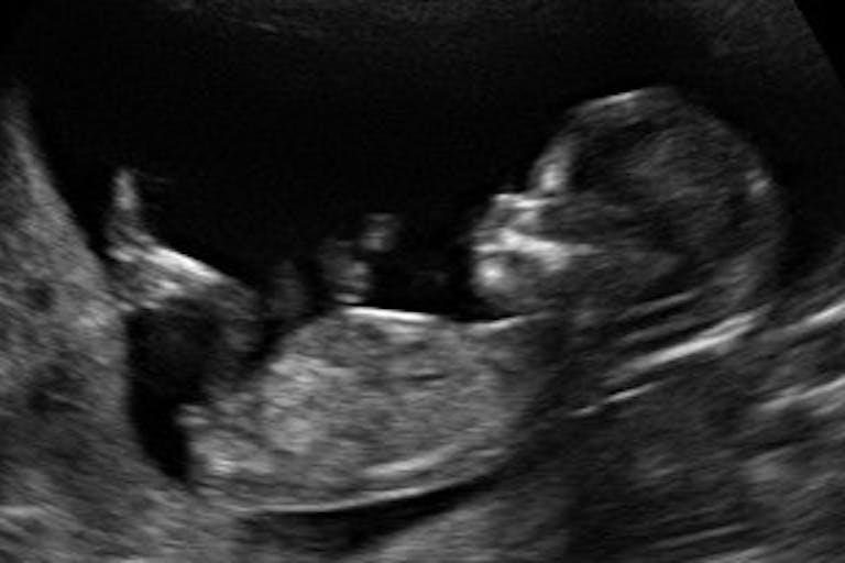 11 week old fetus
