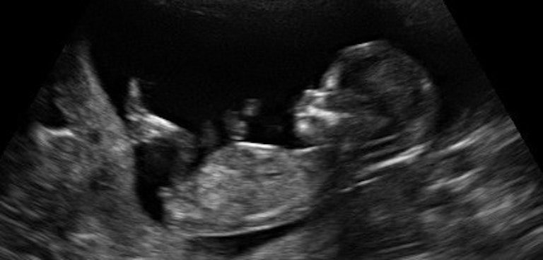 11 week old fetus