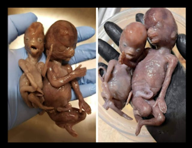 Harvard Medical School under fire for the trafficking of human body parts image