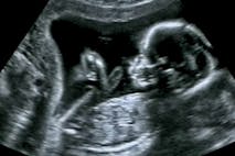 preborn babies, ultrasound, pregnancy centers, abortion, poll, diagnosis