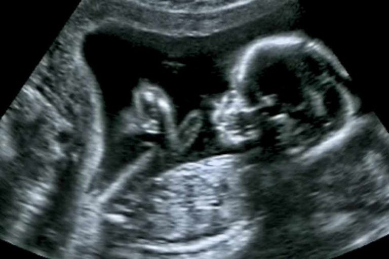 preborn babies, ultrasound, pregnancy centers, abortion, poll, diagnosis