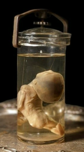 Harvard Medical School under fire for the trafficking of human body parts image