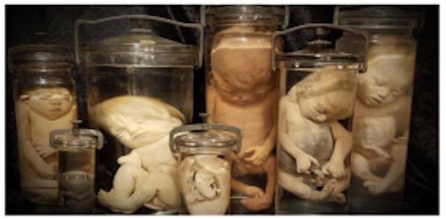 Harvard Medical School under fire for the trafficking of human body parts image
