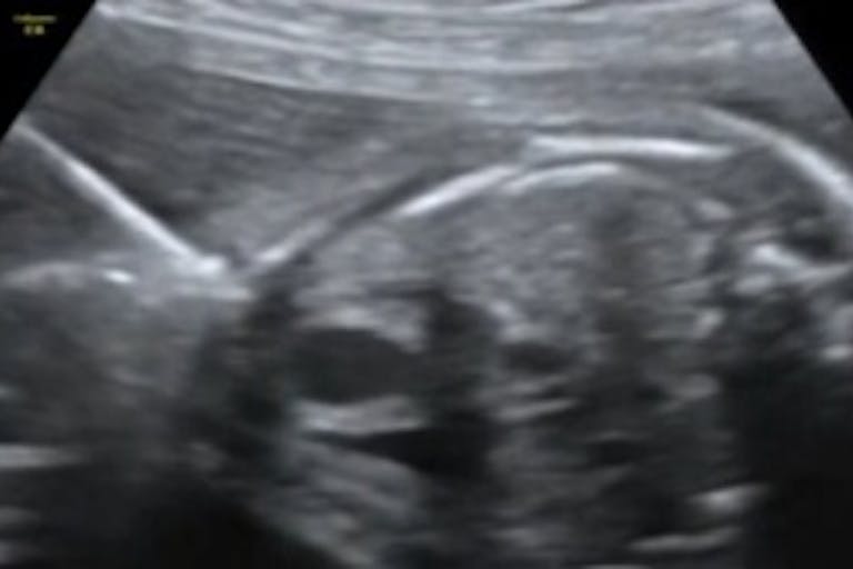 ultrasound