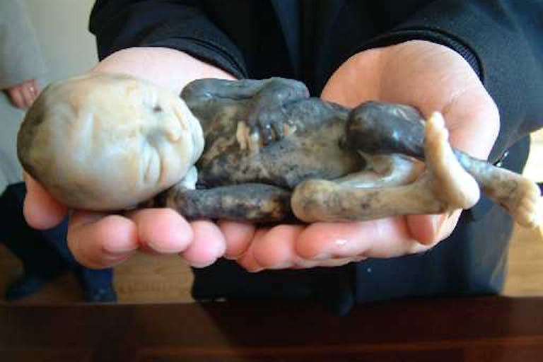 Baby aborted by the saline method. From Priests for Life’s archives WATCH: Theresa was pressured into an abortion she never wanted image