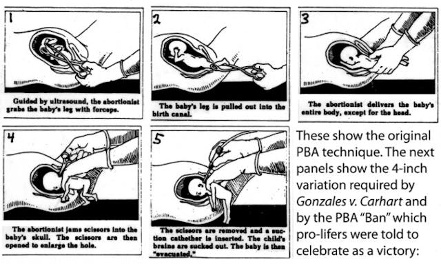 Nurse witnesses partial birth abortions of 9-month-old infants image