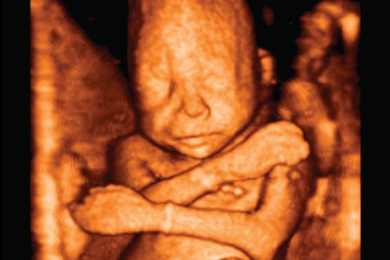 Ultrasound at 22 weeks Ambulance called as woman hemorrhages after elective abortion on 24-week baby image