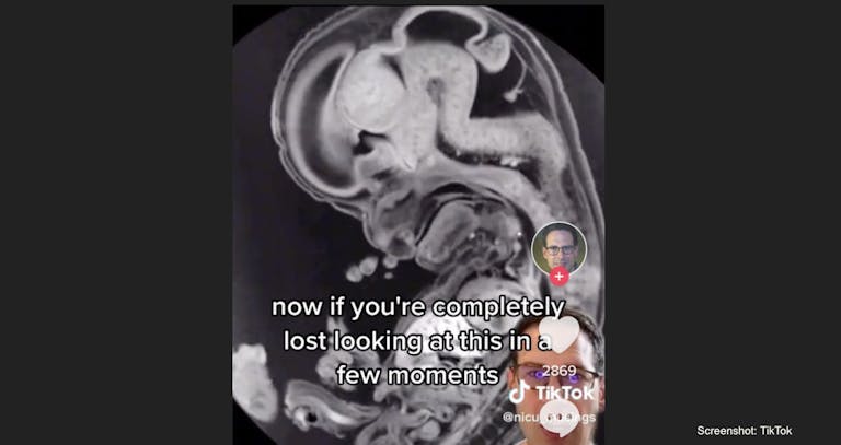 MRI 9-week embryo