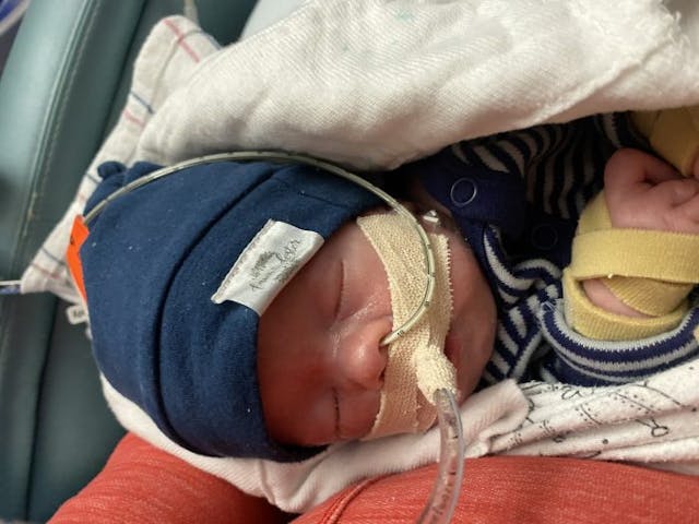 Baby Abel. Do not reprint. twins, trisomy 18, abortion