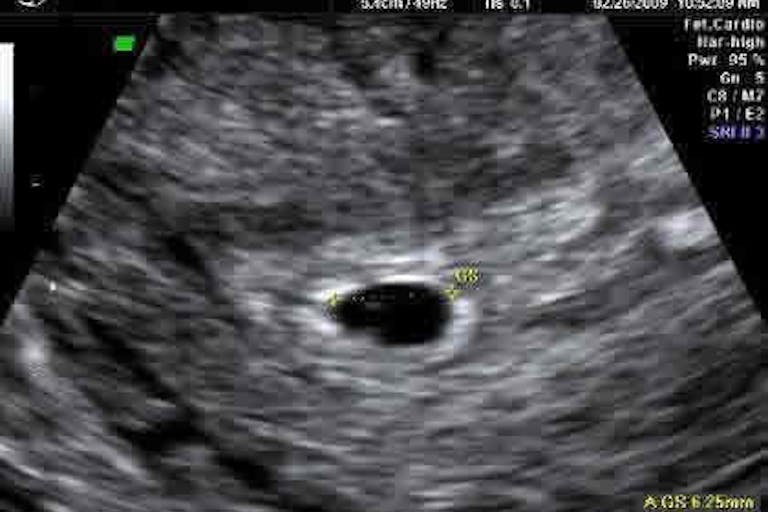5-week-ultrasound