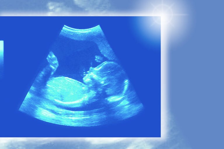 20-week baby scan