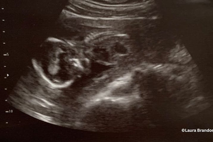 abortion pill, abortion survivor, abortion