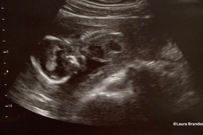 abortion pill, abortion survivor, abortion