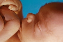 Baby at 20 weeks, the age at which Dermish commits abortions preborn baby, babies, Illinois, aborted, abortion, abortionist, Planned Parenthood
